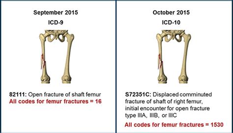 This is the American <b>ICD</b>-<b>10</b>-CM version of S72. . Left femur fx icd 10